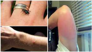 Защо летият започва да хапе през август. Защо лети хапят през есента